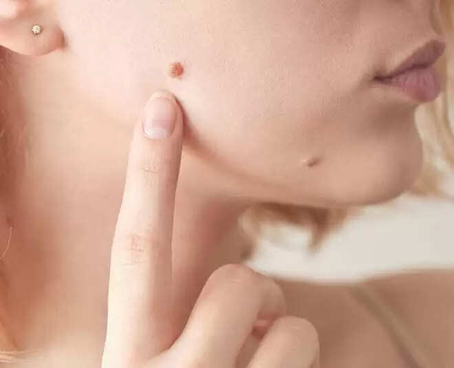 मस्सों से छुटकारा पाने के घरेलू उपाय
