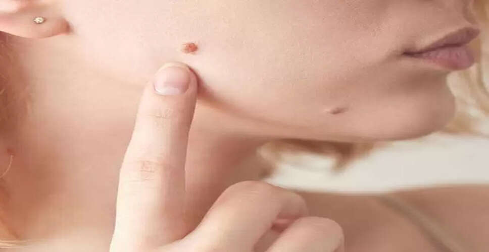 मस्सों से छुटकारा पाने के घरेलू उपाय