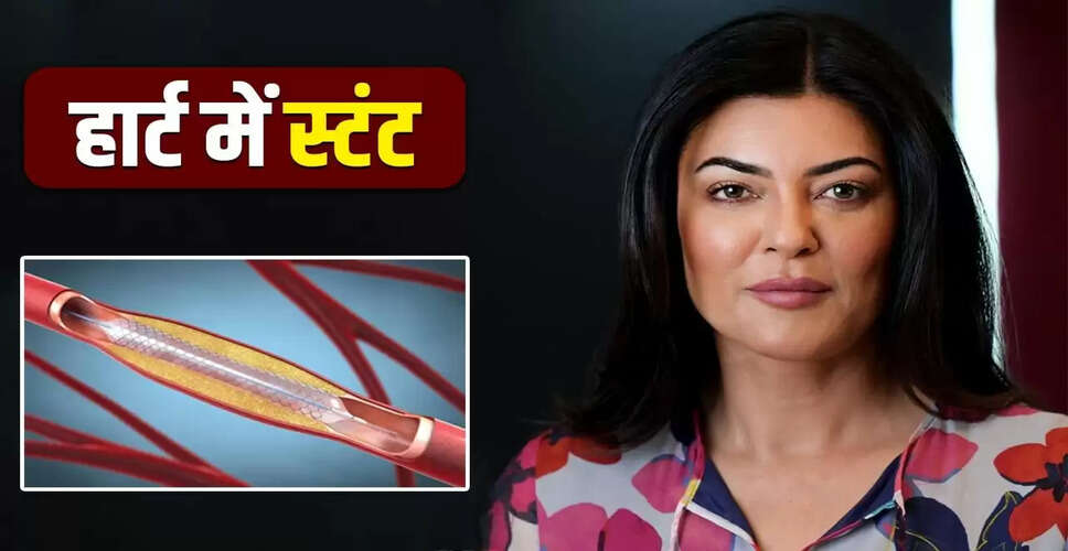 क्या बिना बेहोश किए हार्ट में स्टंट डाला जा सकता है? जानें सुष्मिता सेन के दावे की सच्चाई