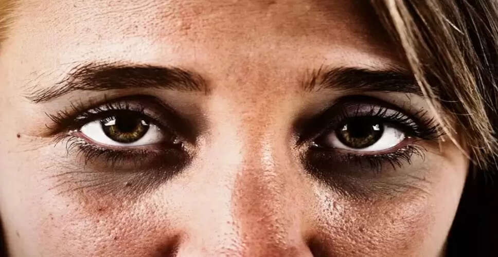 डार्क सर्कल्स से छुटकारा पाने के लिए कैस्टर ऑयल के उपयोग के प्रभावी तरीके