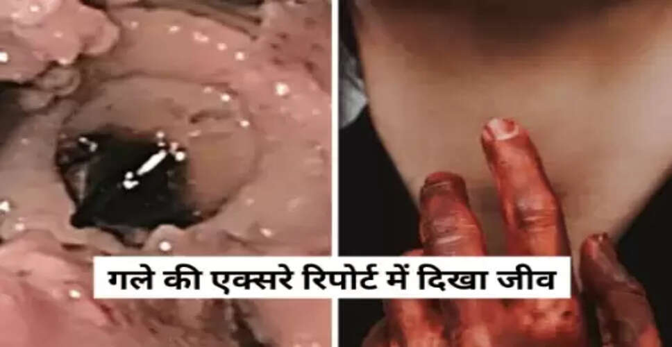 सिंगापुर में गले में फंसा ऑक्टोपस: अनोखी चिकित्सा घटना