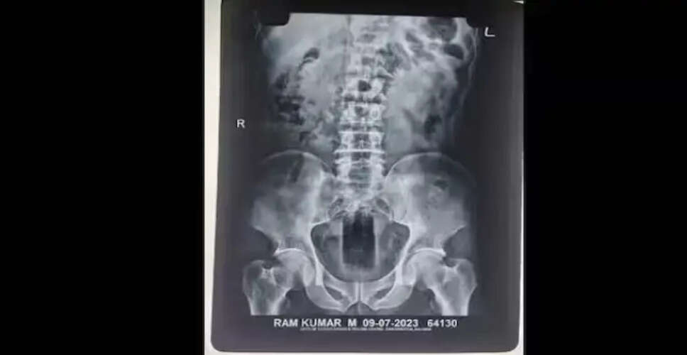 बीकानेर में युवक के गुप्तांग से निकला प्लास्टिक का केन, मामला गंभीर