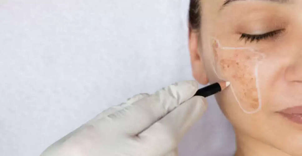 गर्मी में मेलास्मा के उपचार के लिए लेजर तकनीक और सुरक्षा उपाय