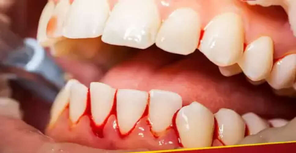 मसूड़ों से खून आने के कारण और बचाव के उपाय