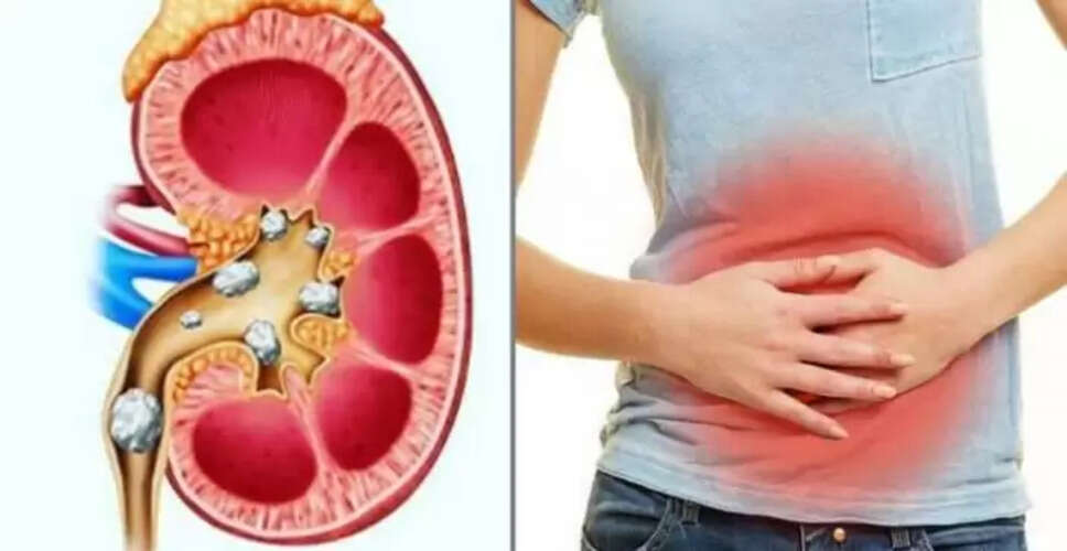 किडनी स्टोन से बचने के लिए किन खाद्य पदार्थों से करें परहेज