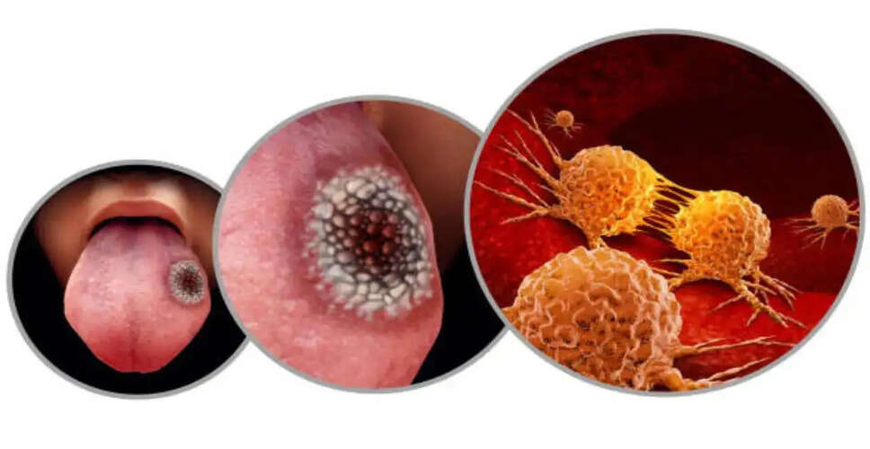 जीभ कैंसर के प्रारंभिक लक्षण और रोकथाम के उपाय