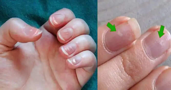 नाखूनों पर धब्बों का महत्व: जानें शुभ-अशुभ संकेत