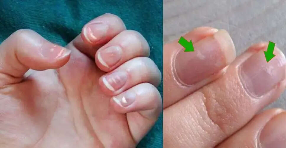 नाखूनों पर धब्बों का महत्व: जानें शुभ-अशुभ संकेत