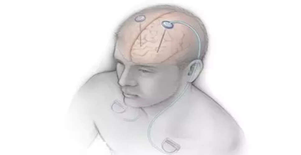 भारत में गहरे मस्तिष्क उत्तेजना पर पहली कार्यशाला का आयोजन
