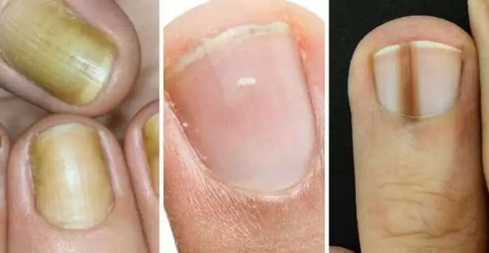 नाखूनों के रंग और बनावट से जानें स्वास्थ्य समस्याएं