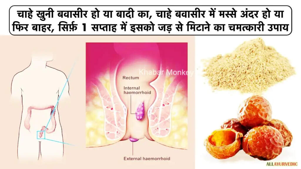 बवासीर: कारण, प्रकार और घरेलू उपचार