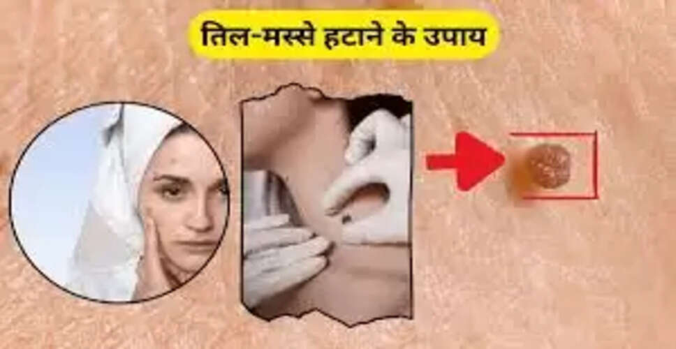 सुरक्षित घरेलू उपाय से मस्से हटाने की विधि
