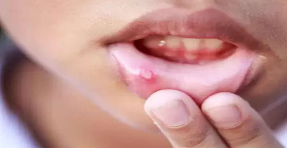 नारियल तेल से लेकर हल्दी तक, मुंह के छालों से देंगे आराम