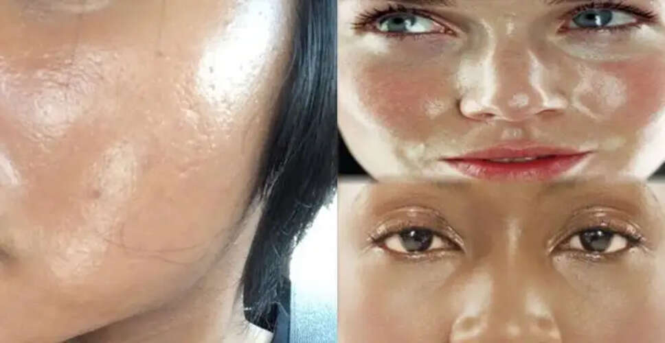 गर्मियों में ऑयली स्किन से राहत पाने के 5 प्रभावी उपाय