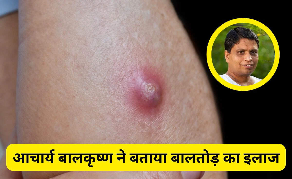 बालतोड़ के प्रभावी घरेलू उपचार: आचार्य बालकृष्ण की सलाह