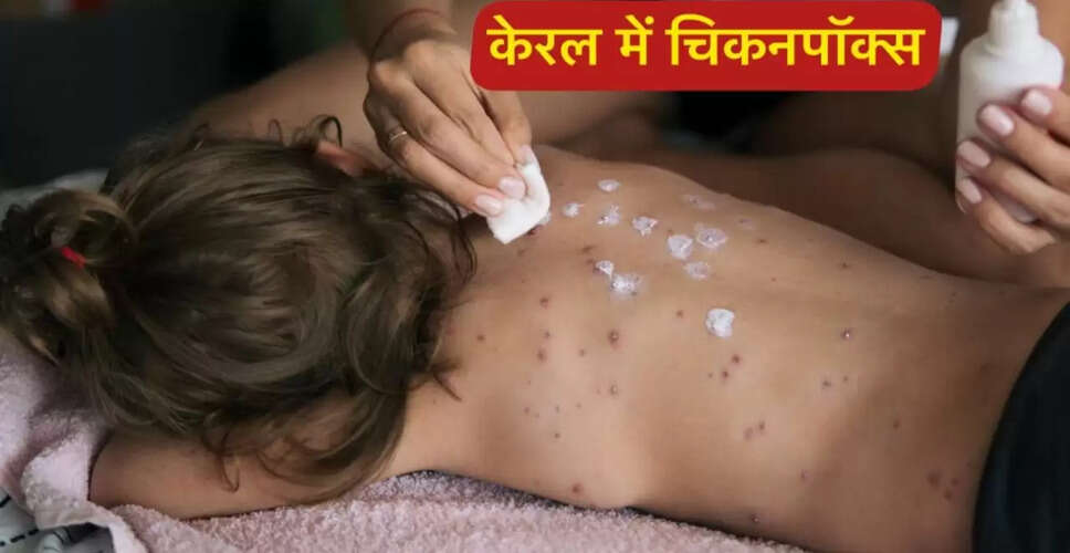 केरल में चिकनपॉक्स के मामलों में तेजी, स्वास्थ्य विभाग ने जारी की चेतावनी