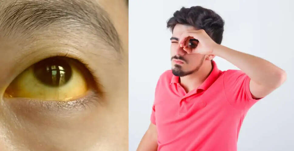 आंखों का पीला होना: जानें 7 गंभीर बीमारियों के संकेत