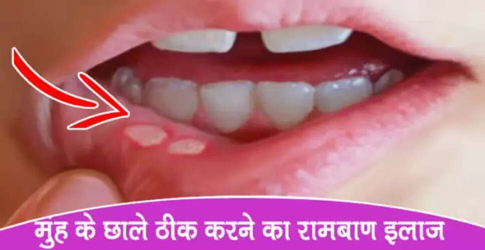 मुँह के छालों का घरेलू उपचार: जानें आसान उपाय