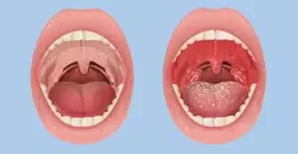 टॉन्सिलाइटिस से राहत पाने के घरेलू उपाय
