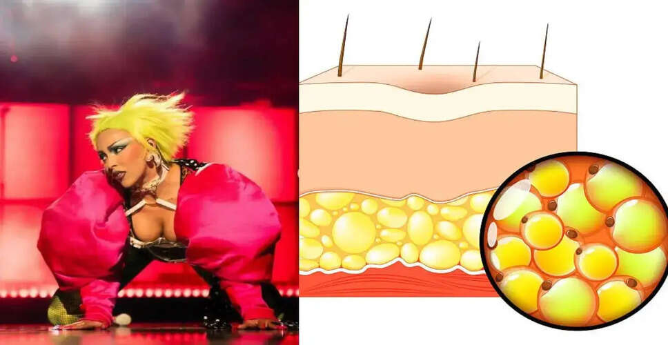 डोजा कैट ने लिपेडिमा के बारे में साझा की जानकारी, जानें इसके लक्षण और उपचार