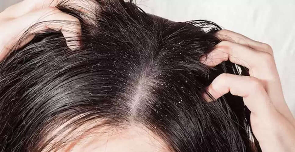 सूखे स्कैल्प से राहत पाने के लिए घरेलू उपाय