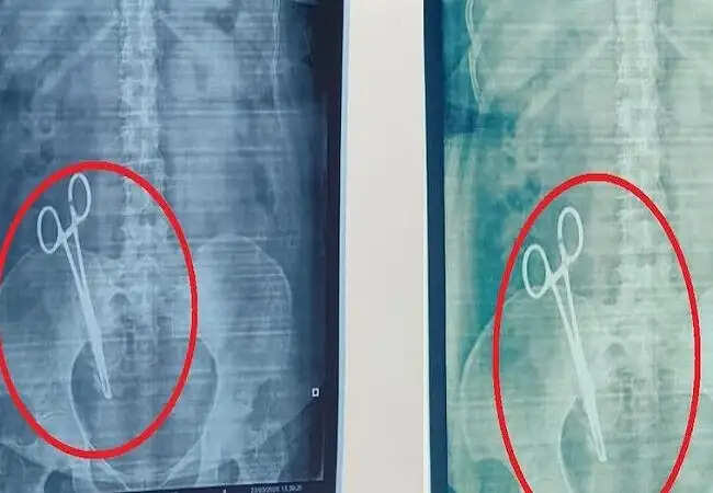 लखनऊ में डॉक्टरों की लापरवाही से महिला के पेट में कैंची छूटी