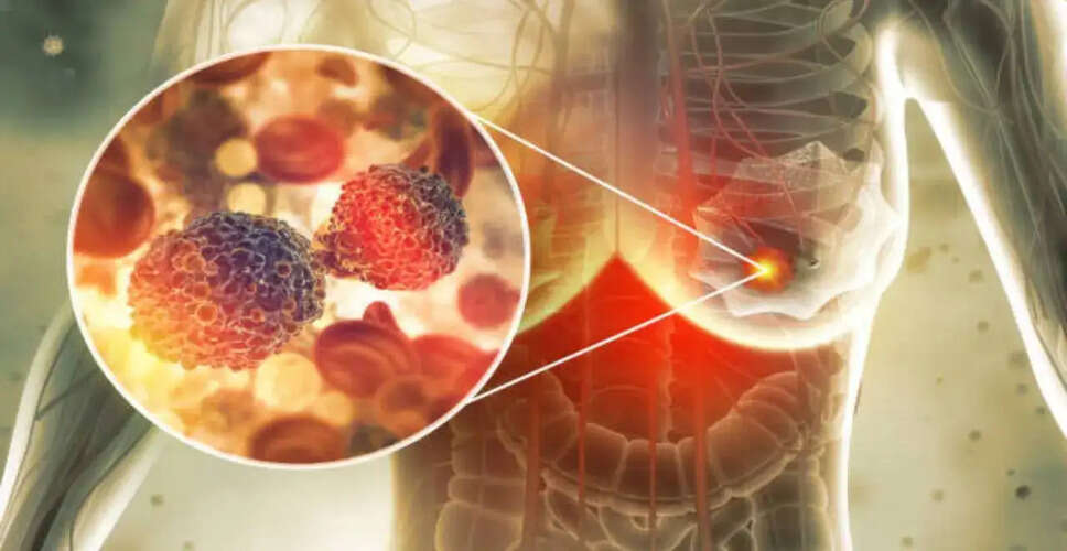 चेन्नई में बढ़ते स्तन कैंसर के मामलों पर चिंता