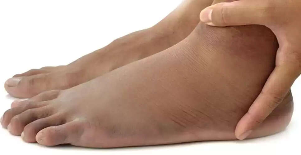 पैरों में सूजन: गंभीर स्वास्थ्य समस्याओं का संकेत