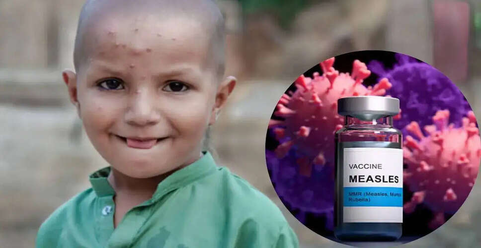 बांग्लादेश में खसरे का प्रकोप: भारत के लिए खतरा?