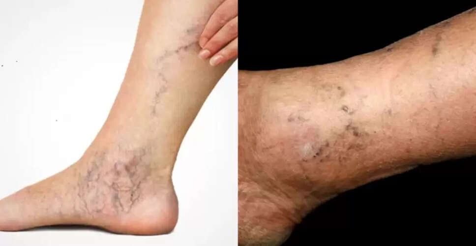 पैरों में अवरुद्ध धमनियों के लक्षण: जानें कैसे पहचानें