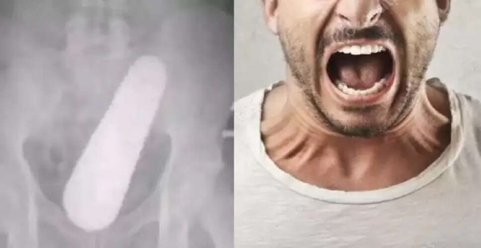 कोलंबिया में अजीबोगरीब सर्जरी: पेट से निकला खीरा