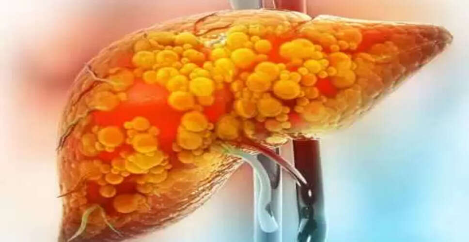 फैटी लिवर के मरीजों के लिए 4 फायदेमंद सब्जियाँ