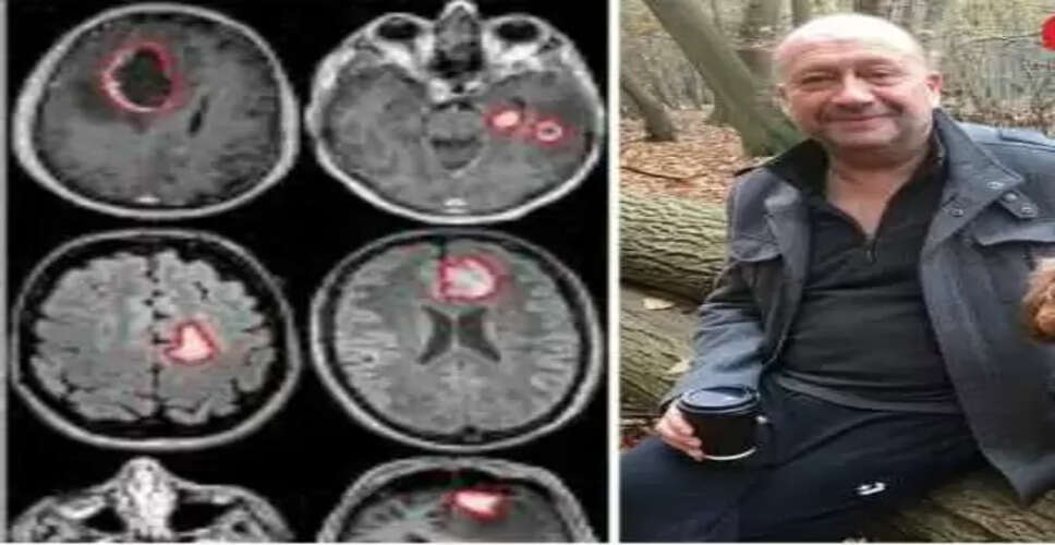 डॉक्टर ने मूड स्विंग को समझा डिप्रेशन, MRI ने खोला बड़ा राज़