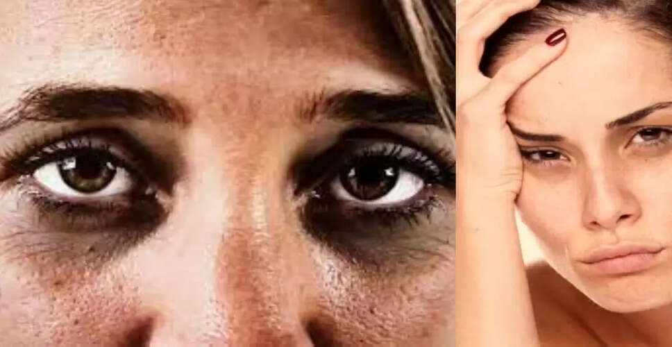 आंखों के नीचे काले घेरे: घरेलू उपायों से पाएं राहत