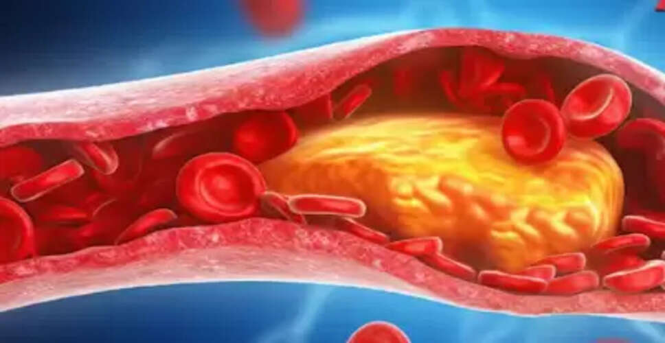 कोलेस्ट्रॉल कम करने के लिए दवा के बिना अपनाएं ये उपाय