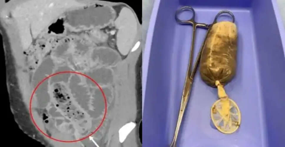 गुस्से में केला निगलने से हुई गंभीर स्थिति, डॉक्टरों ने किया ऑपरेशन