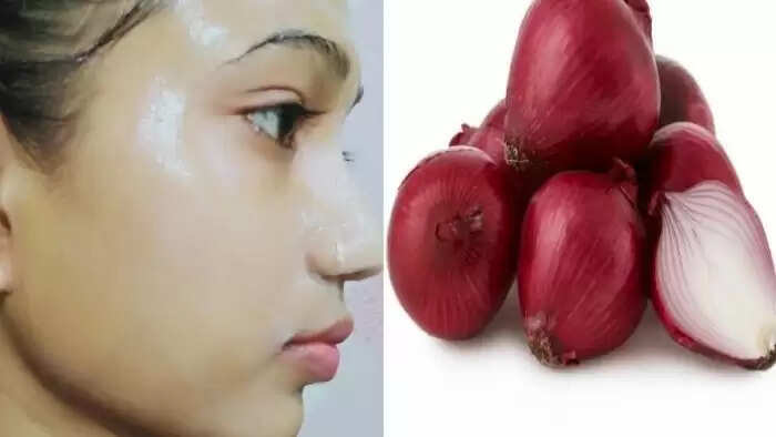 प्याज़ के छिलकों के अद्भुत स्वास्थ्य लाभ