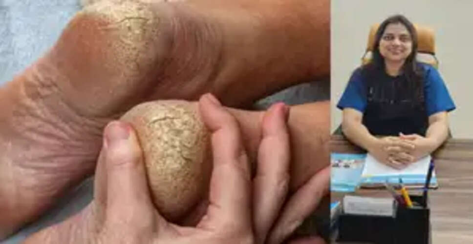 सही त्वचा देखभाल से अब फटी एड़ियों को कहें बॉय-बॉय