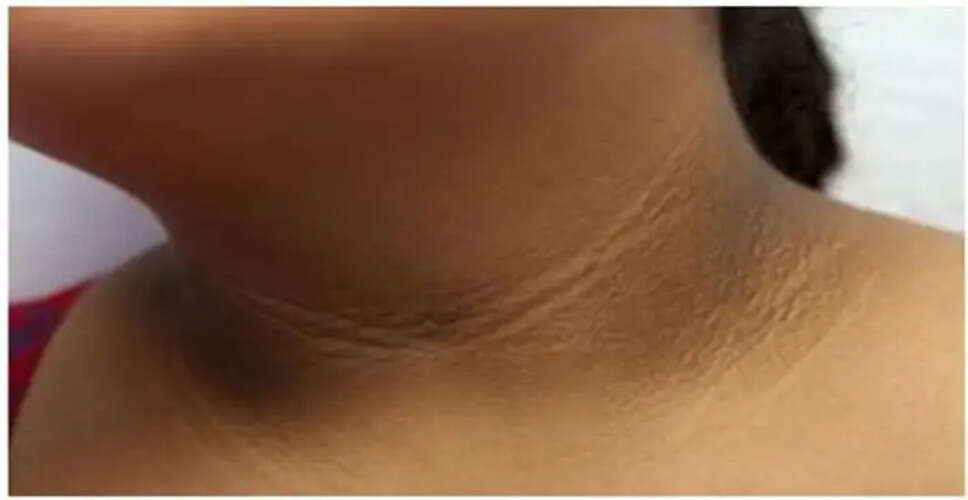 बच्चों में मोटापे के संकेत: गर्दन पर कालापन और स्वास्थ्य जोखिम