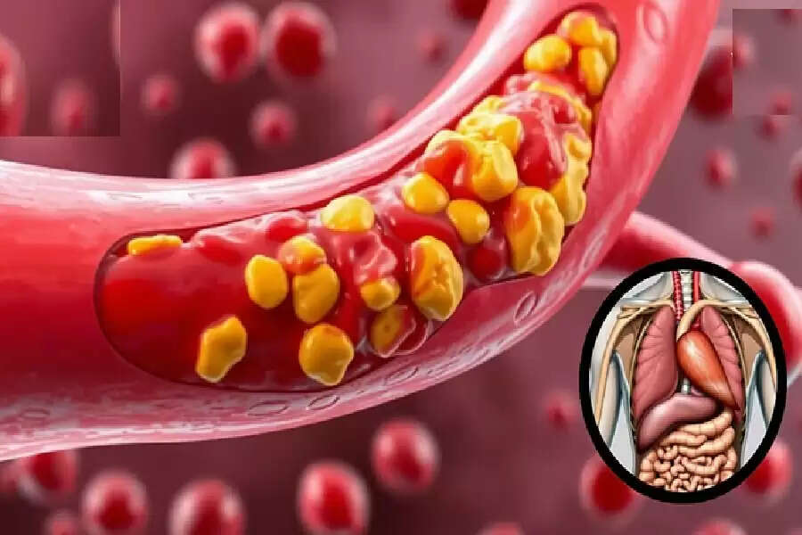 कोलेस्ट्रॉल के बढ़ने से होने वाले स्वास्थ्य जोखिम