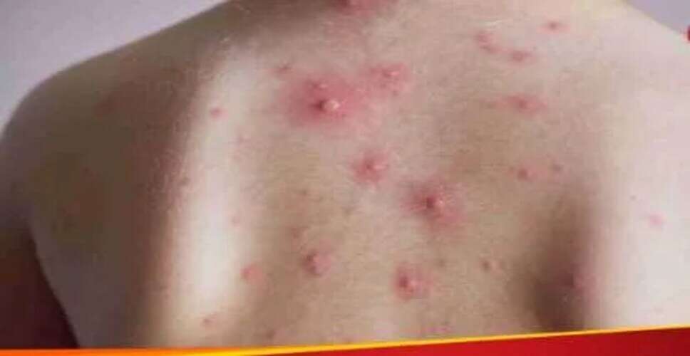 भारत में चिकन पॉक्स को 'माता' क्यों कहा जाता है?