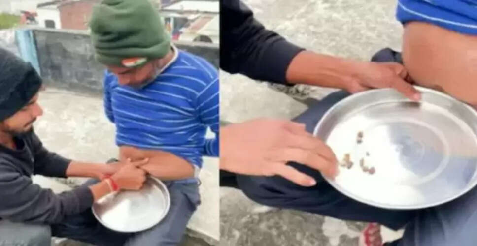 सोशल मीडिया पर वायरल वीडियो: बिना ऑपरेशन किडनी स्टोन्स निकालने का दावा
