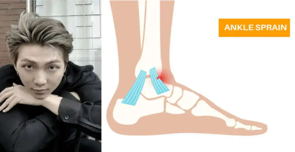 BTS के RM को एंकल चोट, जानें एक्सेसरी नैविकुलर स्प्रेन क्या है