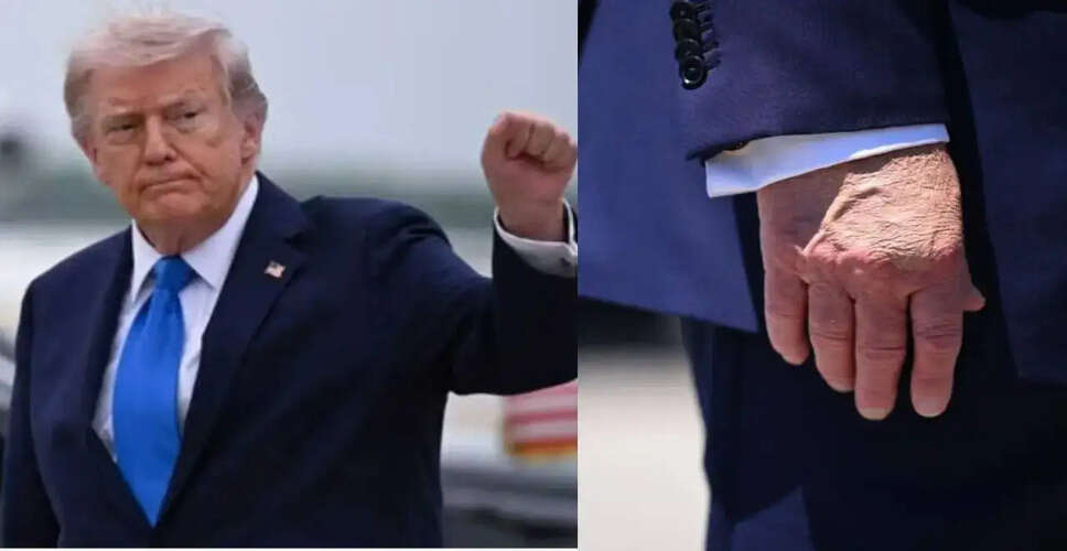 डोनाल्ड ट्रंप की स्वास्थ्य स्थिति पर नई चिंताएँ: क्या संकेत कर रहा है उनका हाथ?