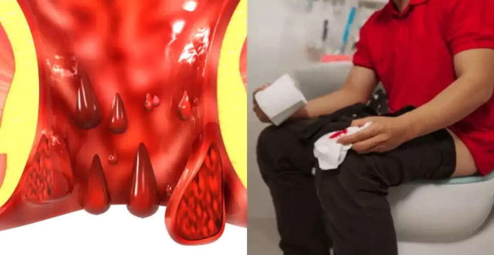 बवासीर के प्रकार और घरेलू उपचार: जानें कैसे पाएं राहत