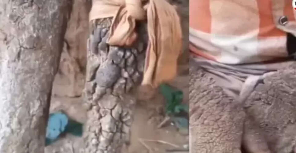 दंतेवाड़ा की राजेश्वरी: दुर्लभ त्वचा रोग से जूझती 14 वर्षीय बच्ची की कहानी