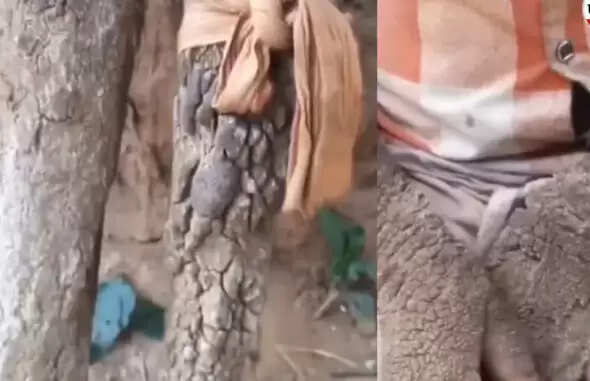 दंतेवाड़ा की राजेश्वरी: दुर्लभ त्वचा रोग से जूझती 14 वर्षीय बच्ची की कहानी