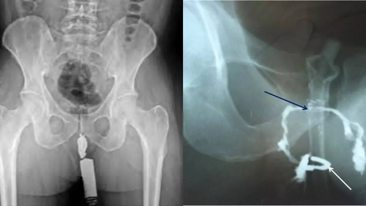 भगंदर (Fistula-in-Ano): लक्षण, कारण और उपचार के उपाय