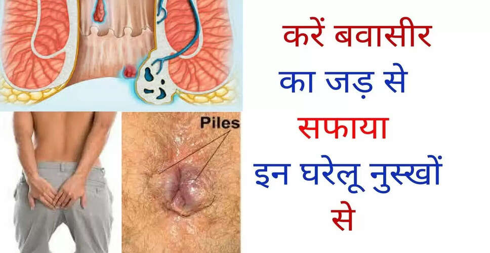 बवासीर: प्रकार, लक्षण और घरेलू उपचार