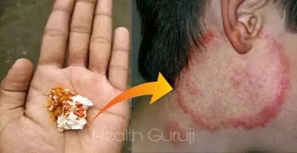 प्राकृतिक उपाय से दाद-खाज और खुजली से पाएं राहत